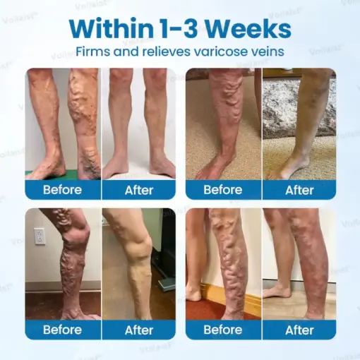 Voilaist® VeinGuard Herbal Spray
